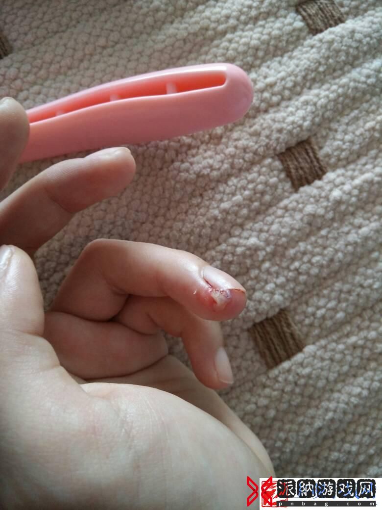 手肉异物